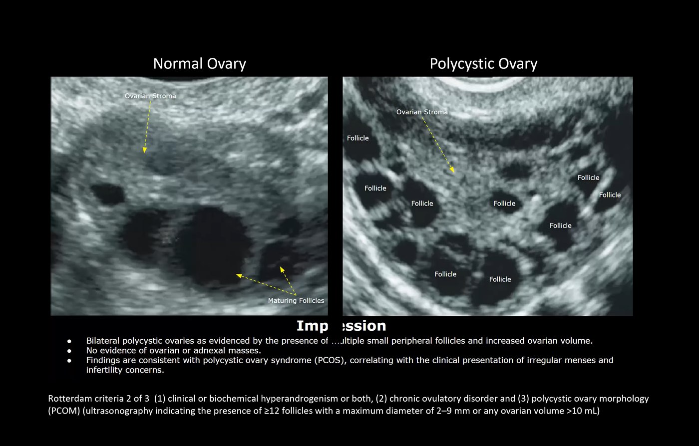 Ultrasound comparison of a normal ovary versus a polycystic ovary — the polycystic ovary shows numerous small peripheral follicles (12 or more, 2–9 mm) and increased ovarian volume, meeting the Rotterdam morphology criterion.
